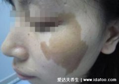 咖啡斑图片怎么治疗才彻底,6个以上咖啡斑