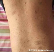 神经纤维瘤图片及早期症状,浑身遍布咖啡