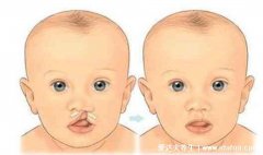 唇腭裂图片是什么样子图片，1侧或2边嘴巴开