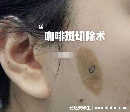 咖啡斑图片怎么治疗才彻底,6个以上咖啡斑警惕神经纤维瘤