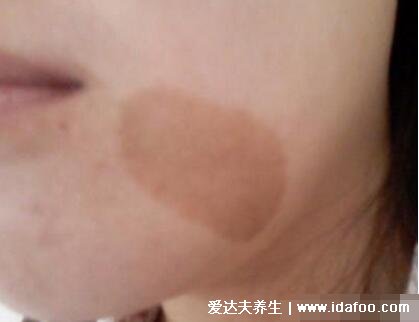 咖啡斑图片怎么治疗才彻底,6个以上咖啡斑警惕神经纤维瘤