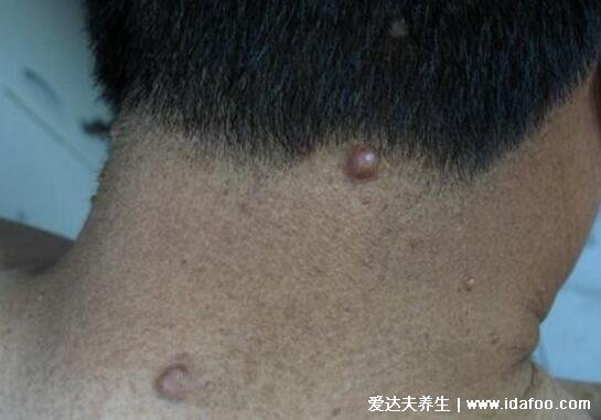 神经纤维瘤图片及早期症状,浑身遍布咖啡斑和柔软有弹性的结节