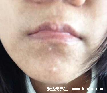 神经纤维瘤图片及早期症状,浑身遍布咖啡斑和柔软有弹性的结节