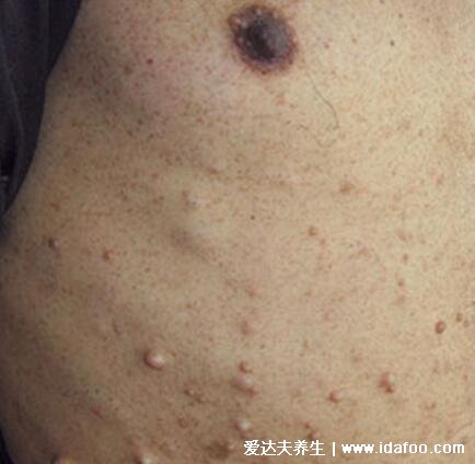 神经纤维瘤图片及早期症状,浑身遍布咖啡斑和柔软有弹性的结节