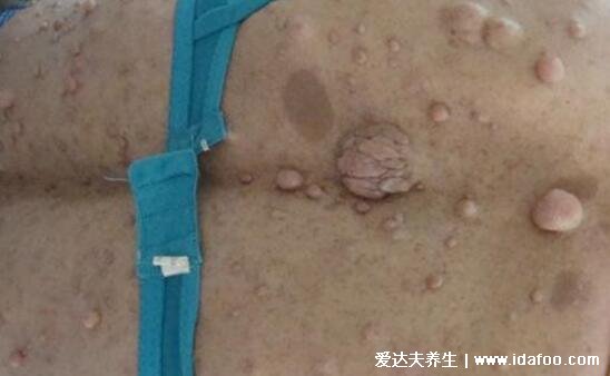 神经纤维瘤图片及早期症状,浑身遍布咖啡斑和柔软有弹性的结节