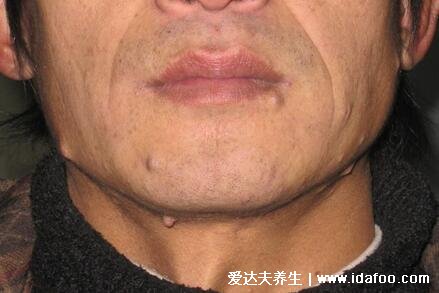 神经纤维瘤图片及早期症状,浑身遍布咖啡斑和柔软有弹性的结节