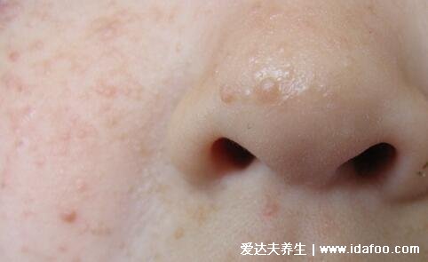 神经纤维瘤图片及早期症状,浑身遍布咖啡斑和柔软有弹性的结节