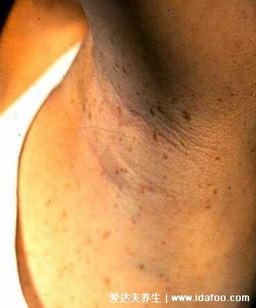神经纤维瘤图片及早期症状,浑身遍布咖啡斑和柔软有弹性的结节