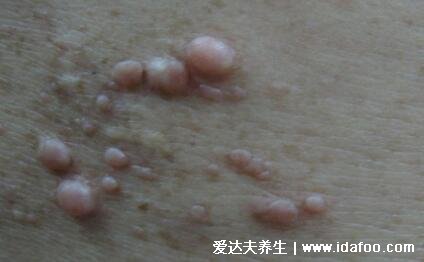 神经纤维瘤图片及早期症状,浑身遍布咖啡斑和柔软有弹性的结节