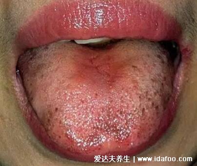 软下疳初期症状图片，生殖器的脓疱发展成痛性溃疡(X病)