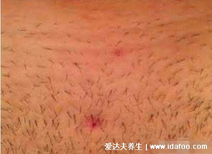 软下疳初期症状图片，生殖器的脓疱发展成痛性溃疡(X病)