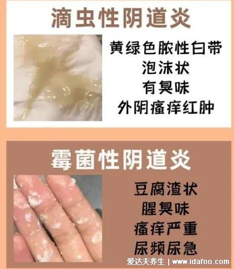 怎么判断霉菌还是滴虫图片,霉菌豆腐渣样白带很瘙痒