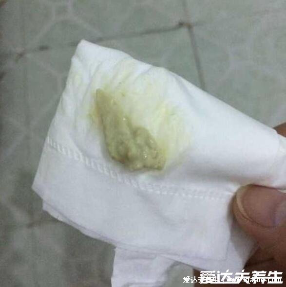 怎么判断霉菌还是滴虫图片,霉菌豆腐渣样白带很瘙痒
