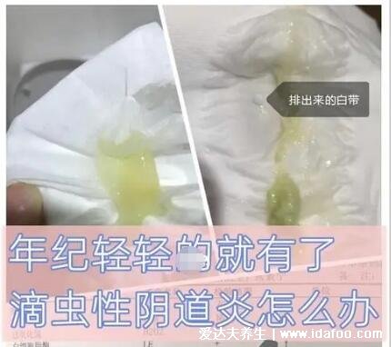 怎么判断霉菌还是滴虫图片,霉菌豆腐渣样白带很瘙痒