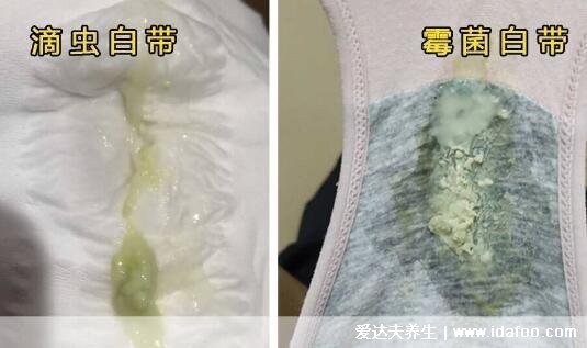 怎么判断霉菌还是滴虫图片,霉菌豆腐渣样白带很瘙痒