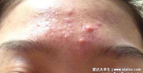 脸部长痘对应五脏的图,两颊长痘对应左肝右肺