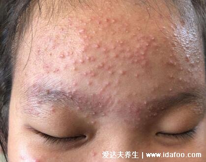 脸部长痘对应五脏的图,两颊长痘对应左肝右肺