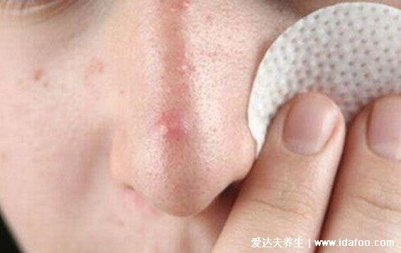 脸部长痘对应五脏的图,两颊长痘对应左肝右肺