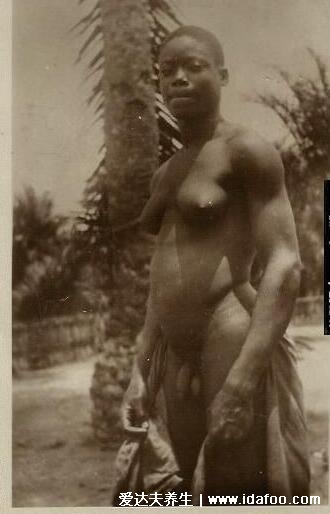 真实双性人图片，同时拥有男女生殖器官(雌雄同体)