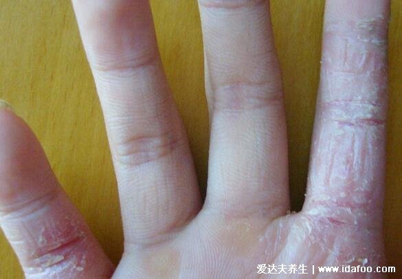 初期手癣鹅掌风症状图片,红色的环形皮疹伴随脱屑瘙痒