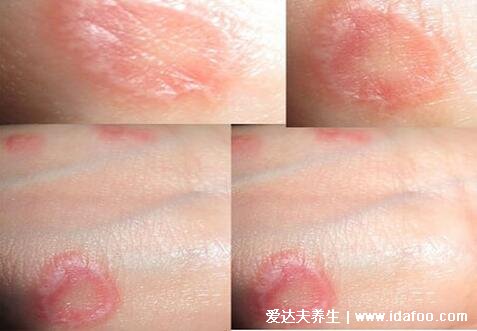 初期手癣鹅掌风症状图片,红色的环形皮疹伴随脱屑瘙痒