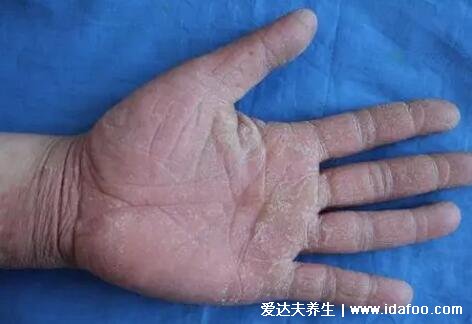 初期手癣鹅掌风症状图片,红色的环形皮疹伴随脱屑瘙痒