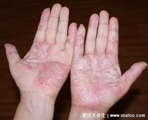 初期手癣鹅掌风症状图片,红色的环形皮疹伴随脱屑瘙痒
