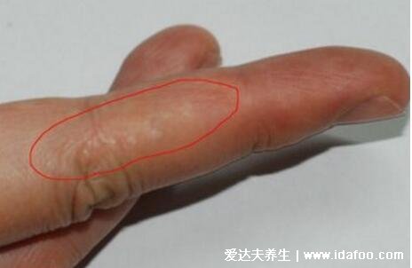 初期手癣鹅掌风症状图片,红色的环形皮疹伴随脱屑瘙痒