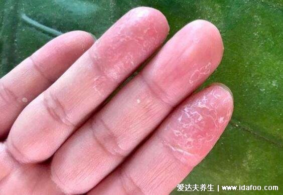 初期手癣鹅掌风症状图片,红色的环形皮疹伴随脱屑瘙痒