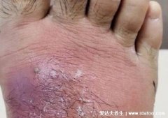 蜂窝组织炎早期图片，小伤口感染细菌引发