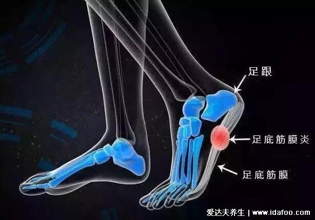 脚底按摩图反射区图片,按摩大脑反射区可治疗头痛