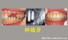 千万不要种植牙，5类人群不建议种植(风险要