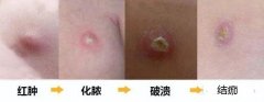 卡介苗正常疤痕图片，正常化脓结痂过程图