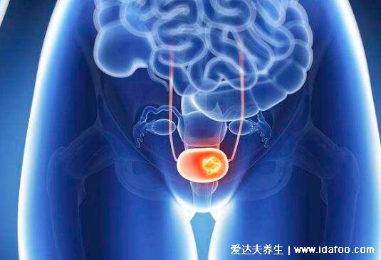 膀胱癌的早期症状图,警惕粉红色的尿液是血尿(5大前兆)