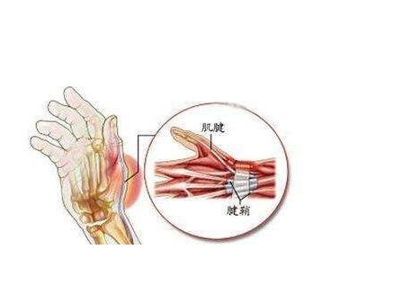 腱鞘炎3个动作自愈方法,试试按摩热敷(过度活动小心加剧)