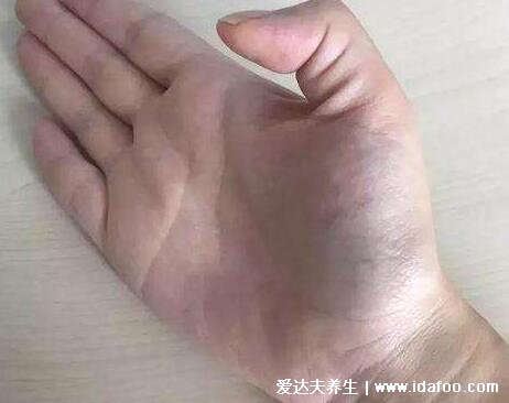 腱鞘炎3个动作自愈方法,试试按摩热敷(过度活动小心加剧)