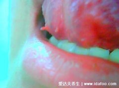 口腔尖锐湿疣图片及症状,初期舌下长米粒