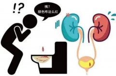 膀胱癌的早期症状图，警惕粉红色的尿液是