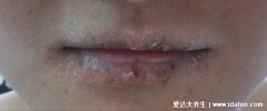 嘴唇干燥紧绷有灼热感怎么办，上火或唇炎