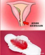 子宫癌的早期症状图片,YD出血排出脓性分泌