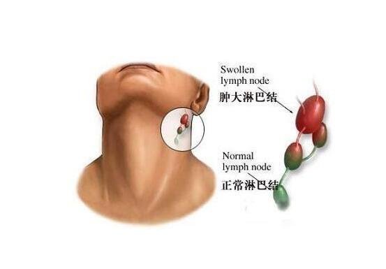 女人艾滋病最明显特征图片，女人艾滋病的三大症状