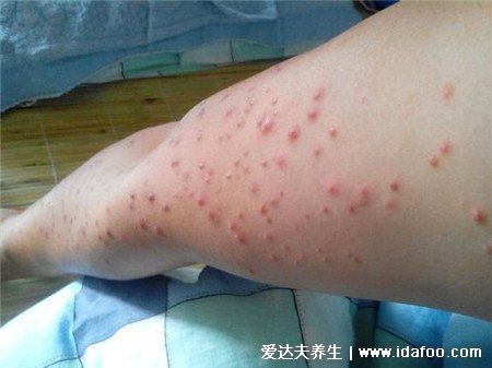 女人艾滋病最明显特征图片，女人艾滋病的三大症状