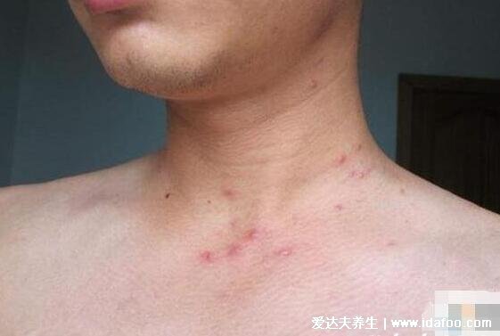 女人艾滋病最明显特征图片，女人艾滋病的三大症状