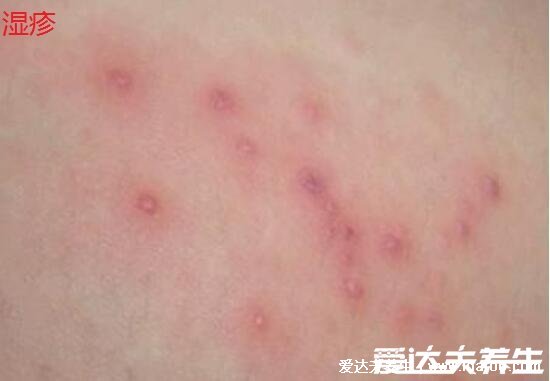 新生儿脸上有小红点图解,中毒性红斑是新生儿常见疾病(3种可能)