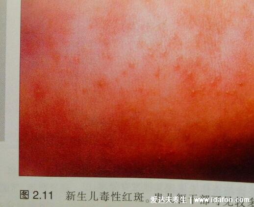 新生儿脸上有小红点图解,中毒性红斑是新生儿常见疾病(3种可能)
