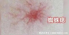 蜘蛛痣图片初期症状，可能是肝癌的早期表