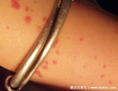 胳膊上有小红点像血点图片，可能是过敏性