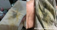 细菌性阴炎的主要症状图片,灰白色稀薄状