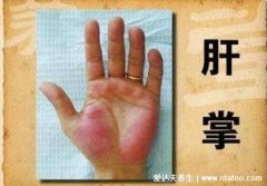 真实肝掌图片初期症状,找准大小鱼际位置