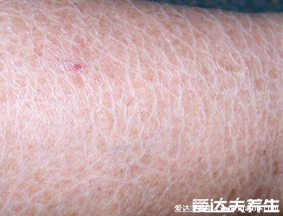 皮肤干燥脱屑像雪花图片,过热水洗澡可导致皮肤干燥症(4种可能)